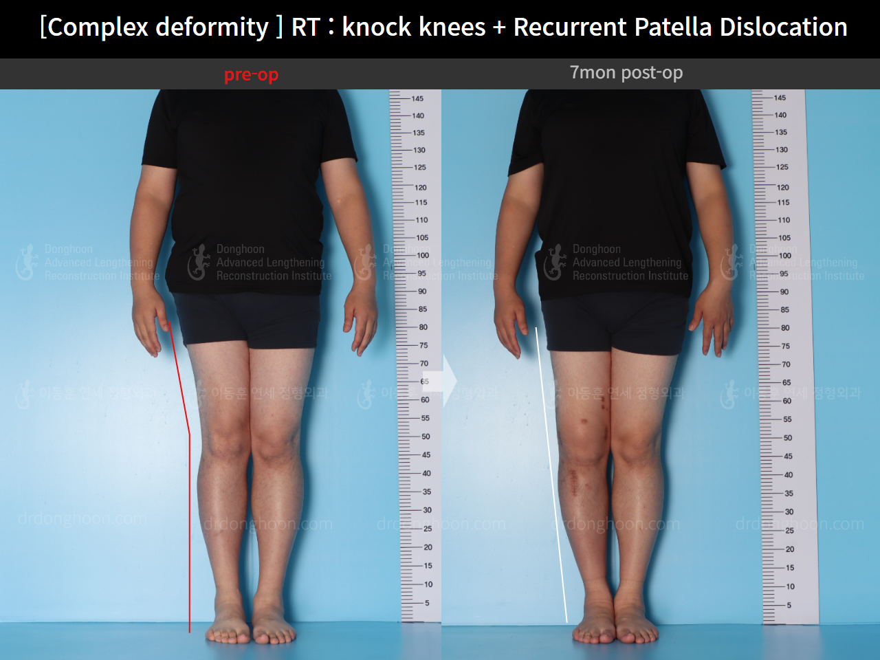 Before and after adult knock knees, case 16147021, image 2, Dr. Donghoon institute (DALRI)