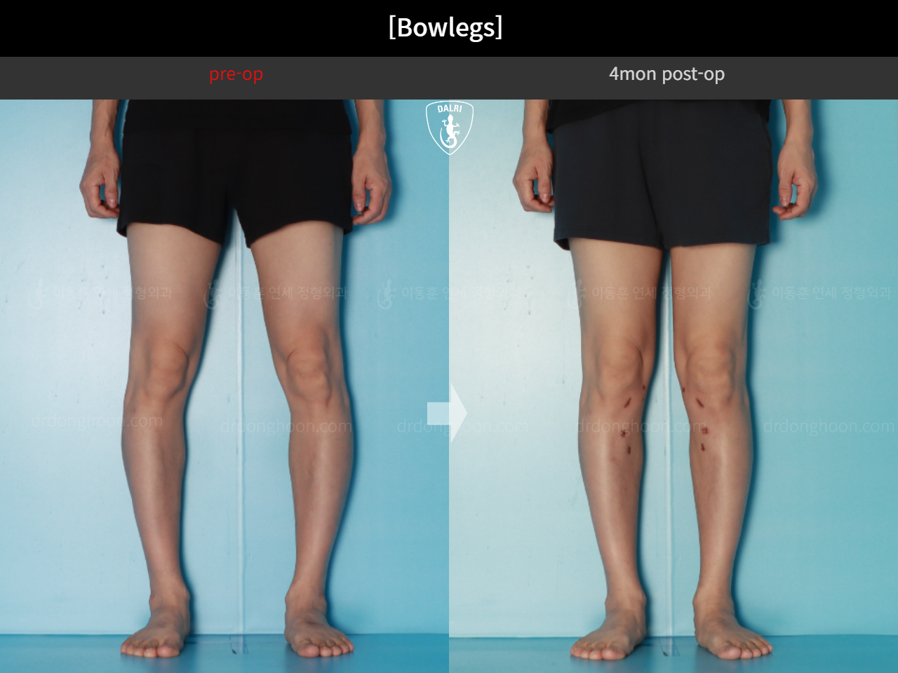 Before and after adult bowlegs, case 17962599, image 10, Dr. Donghoon institute (DALRI)