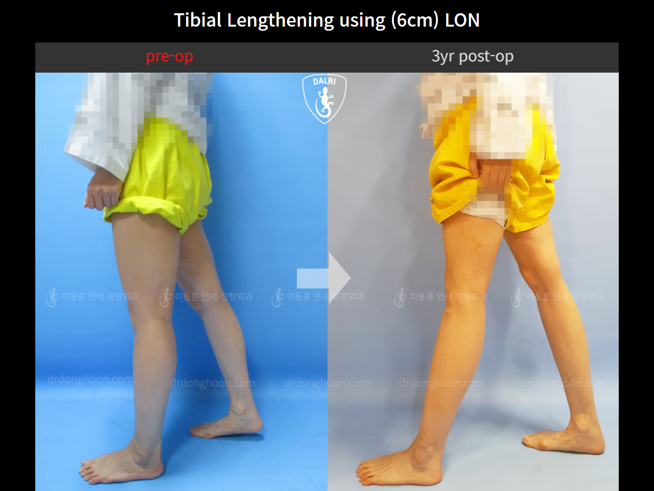 Before and after cll lon, case 4323981, image 4, Dr. Donghoon institute (DALRI)