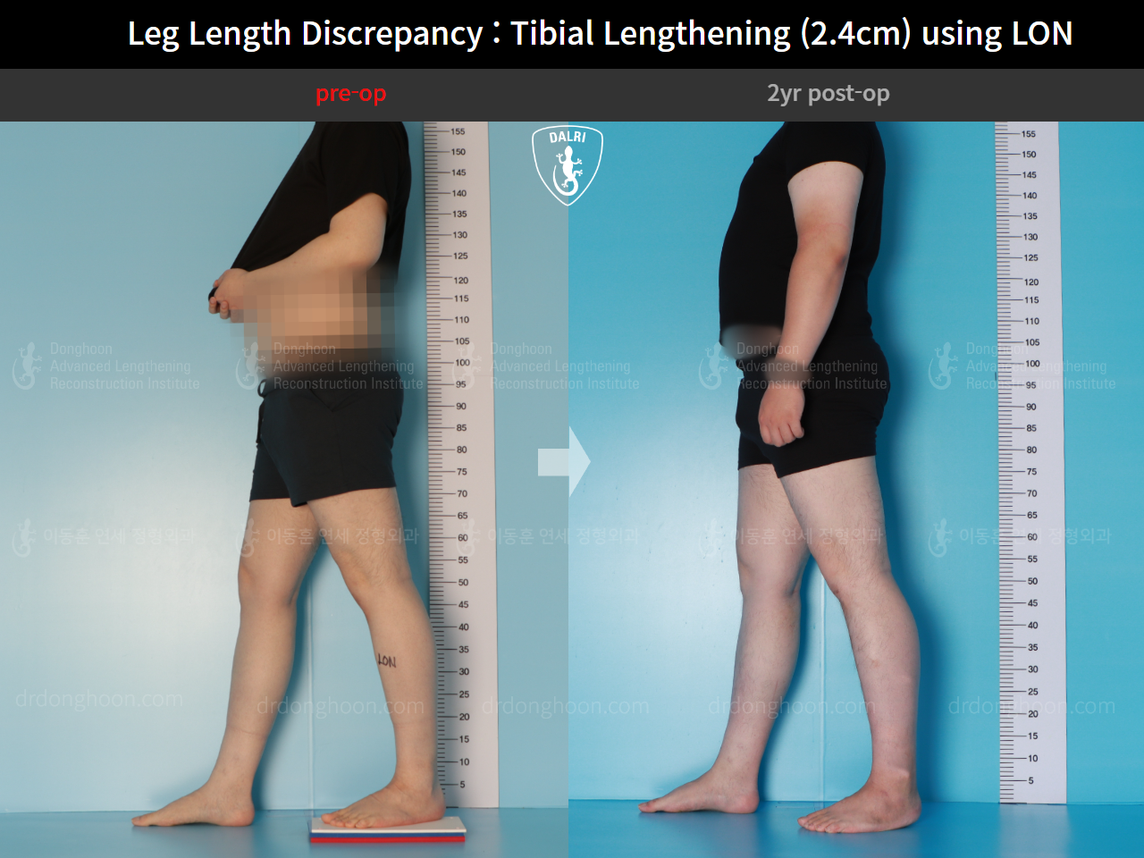 Before and after adult lld, case 15877698, image 4, Dr. Donghoon institute (DALRI)
