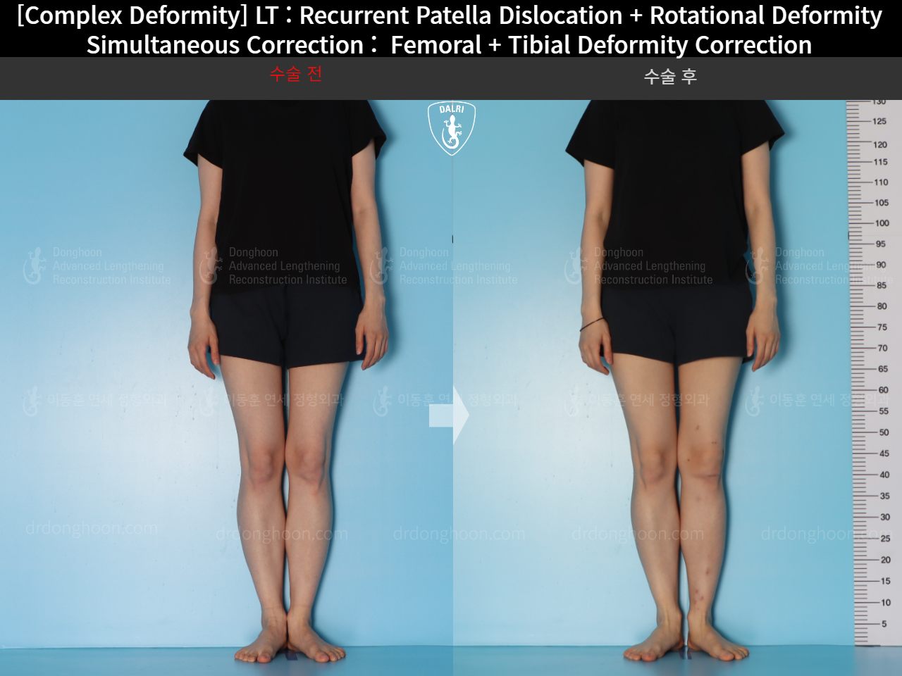 Before and after adult bowlegs, case 18088212, image 6, Dr. Donghoon institute (DALRI)