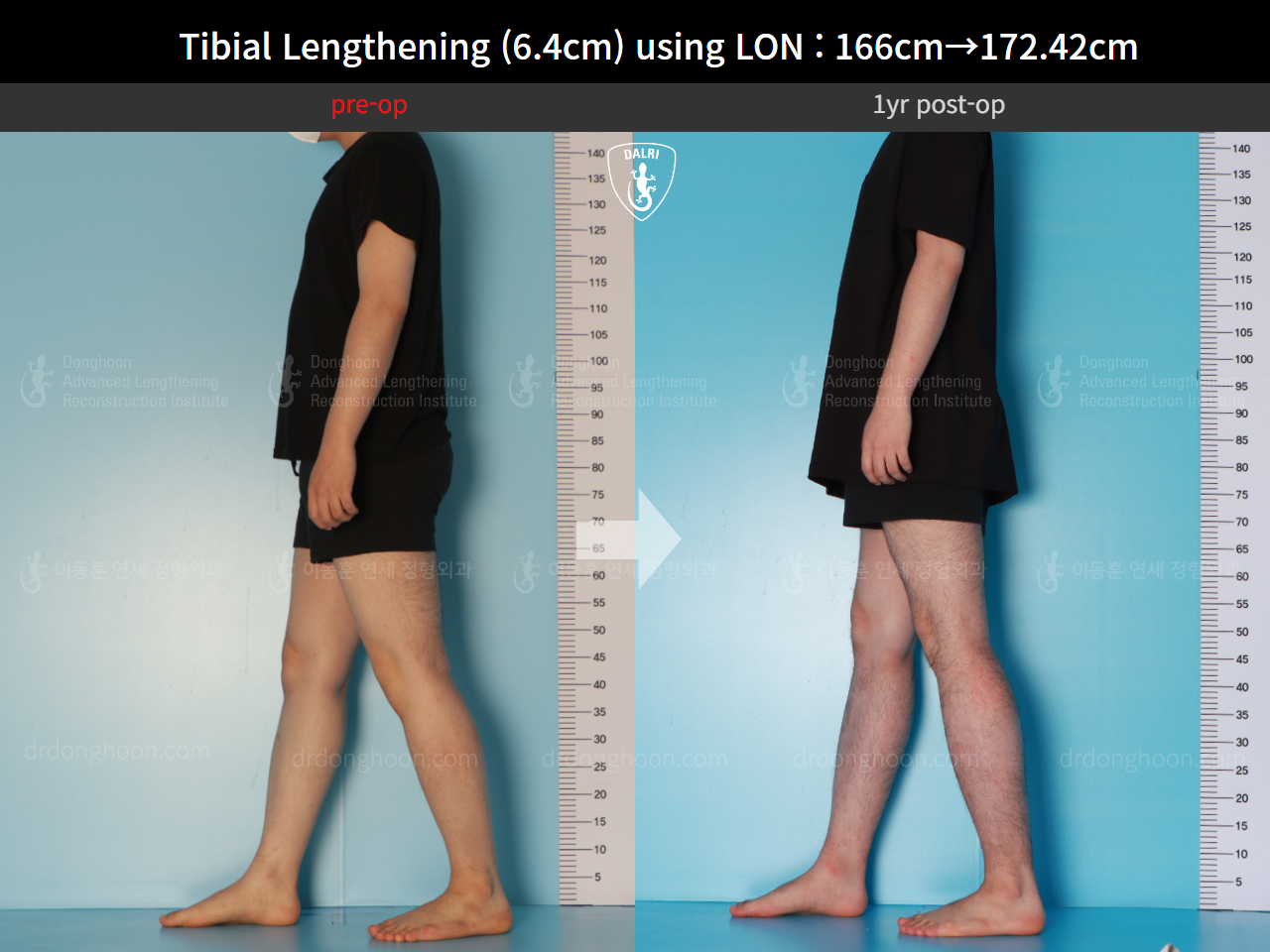 Before and after cll lon, case 15889727, image 5, Dr. Donghoon institute (DALRI)