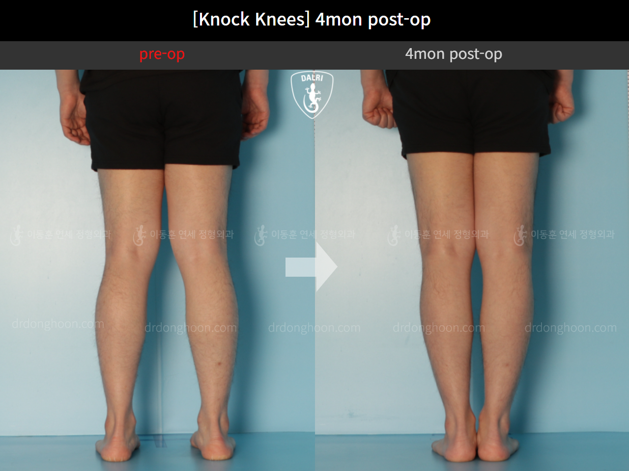 Before and after adult knock knees, case 10599771, image 7, Dr. Donghoon institute (DALRI)