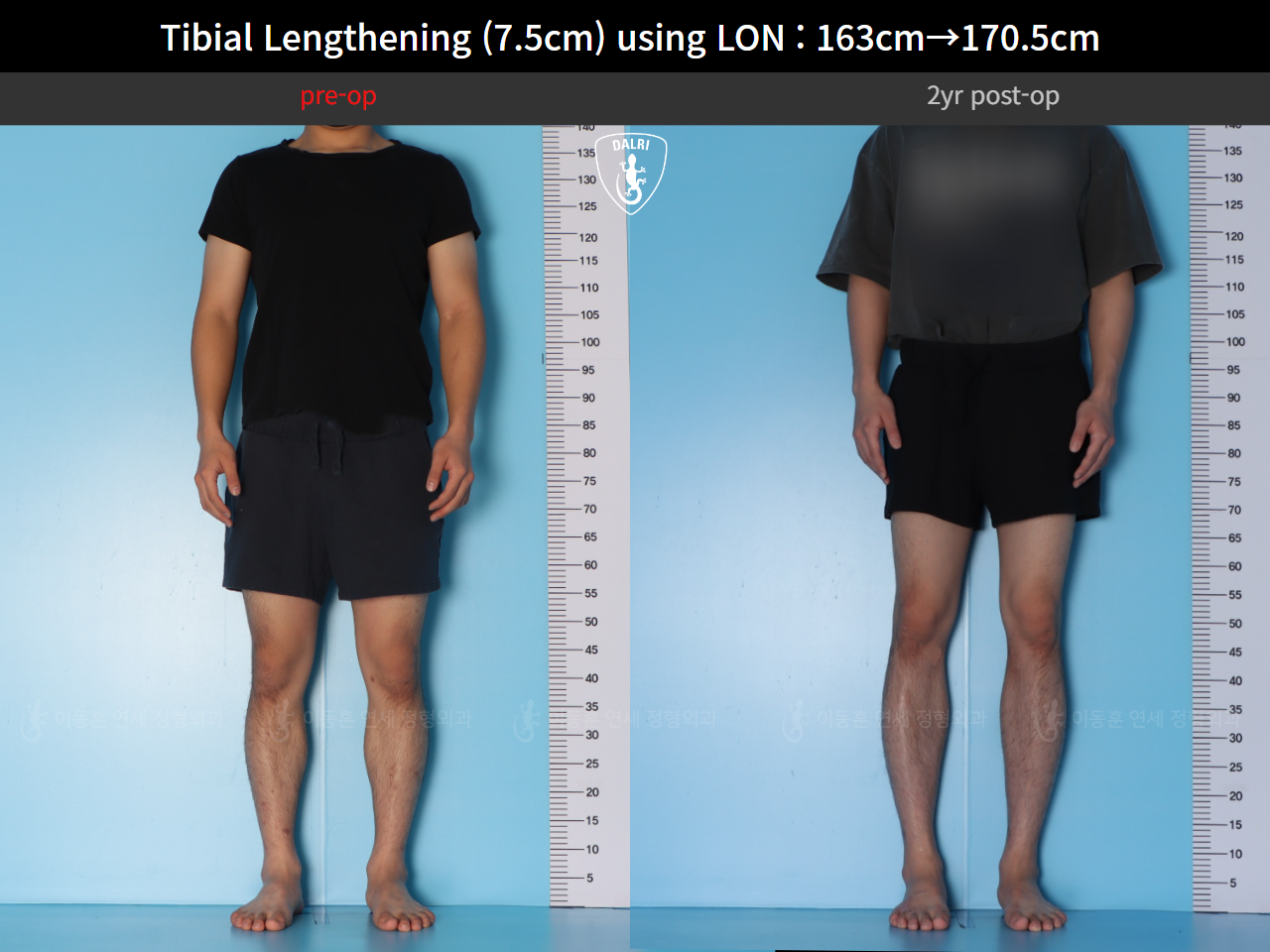 Before and after cll lon, case 125785462, image 2, Dr. Donghoon institute (DALRI)
