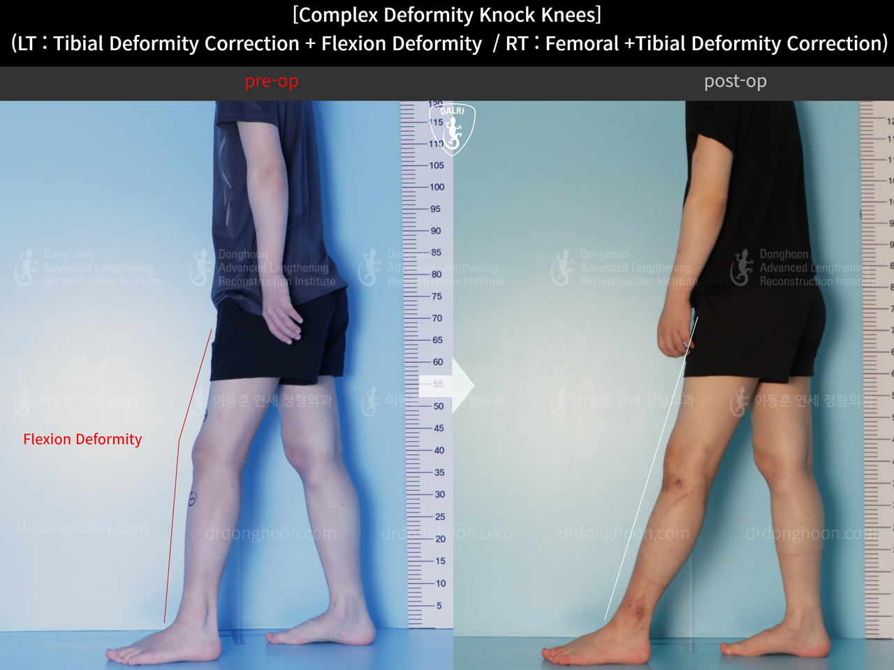 Before and after adult knock knees, case 14439339, image 5, Dr. Donghoon institute (DALRI)