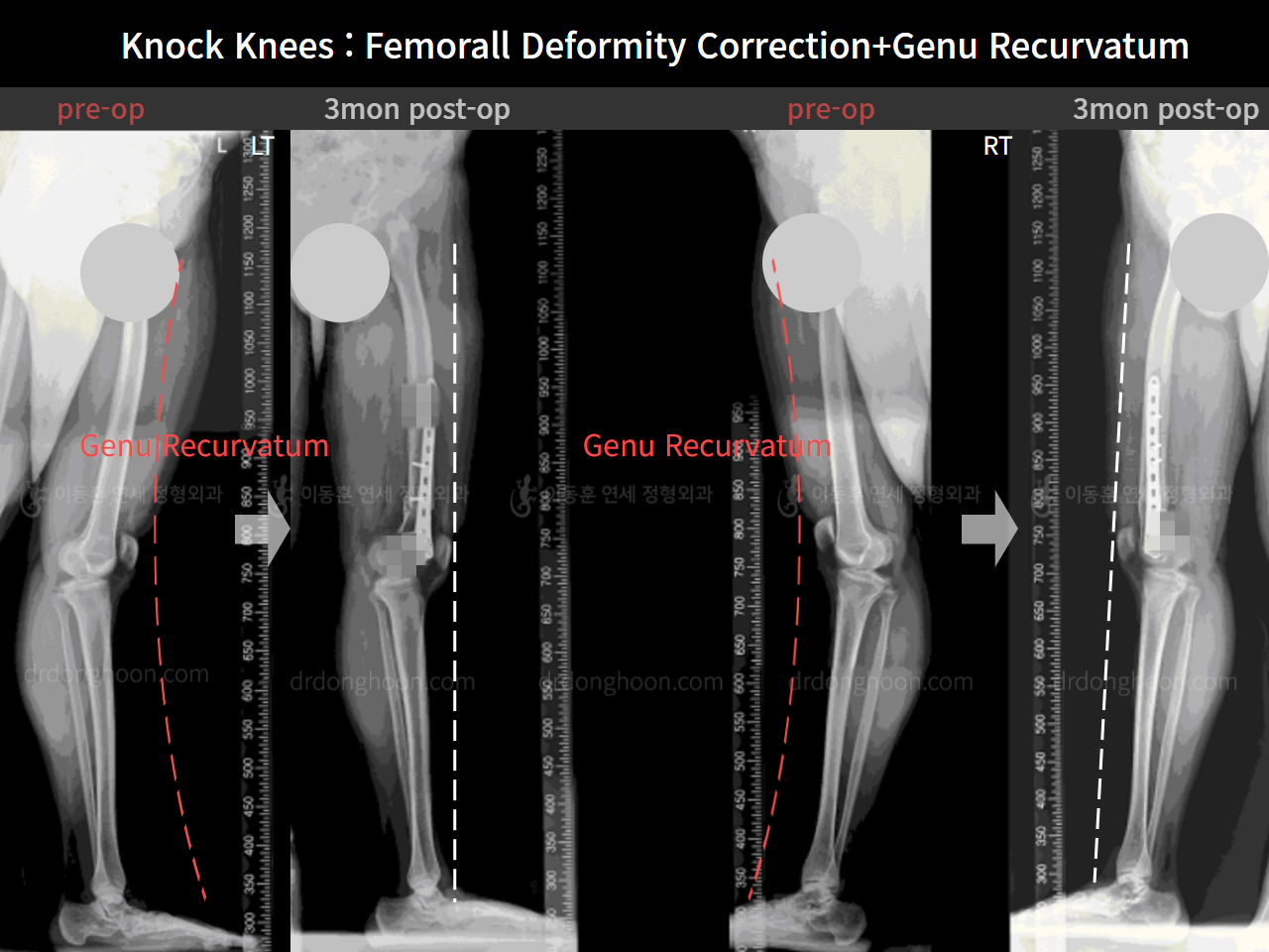 Before and after adult knock knees, case 7165631, image 7, Dr. Donghoon institute (DALRI)