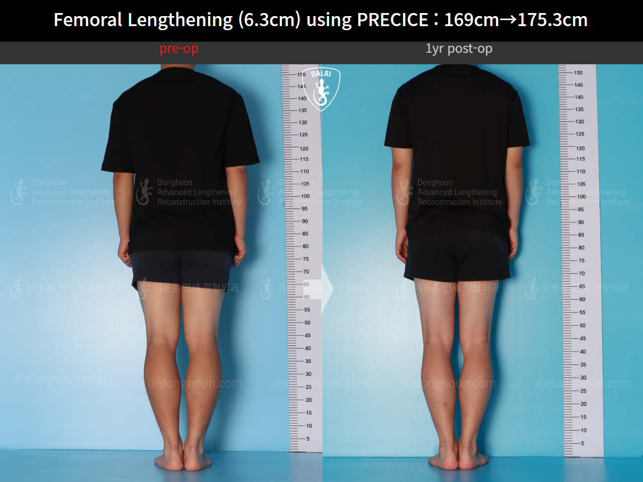 Before and after cll precice, case 16070058, image 3, Dr. Donghoon institute (DALRI)