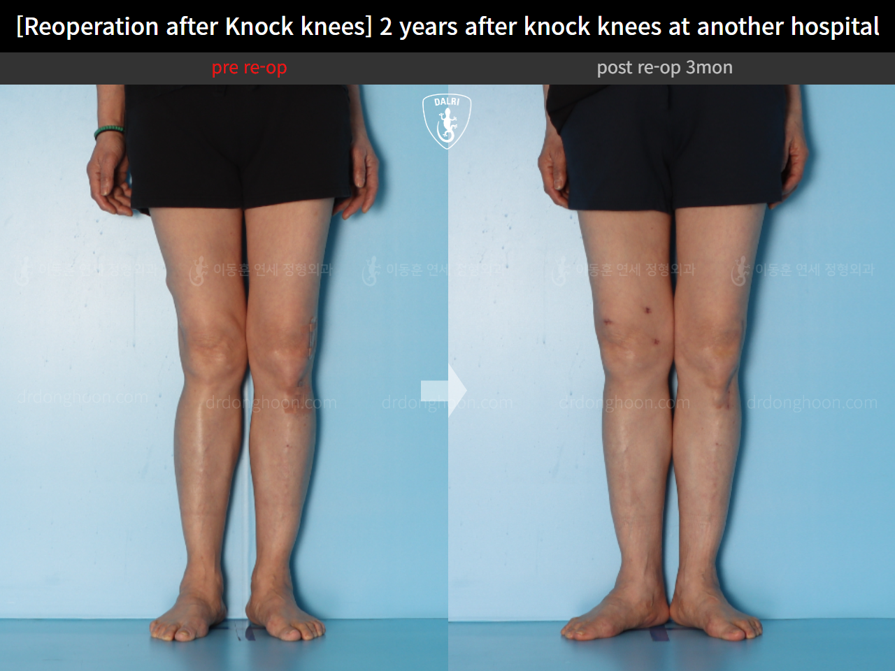 Before and after reoperation after deformity correction, case 15622876, image 7, Dr. Donghoon institute (DALRI)