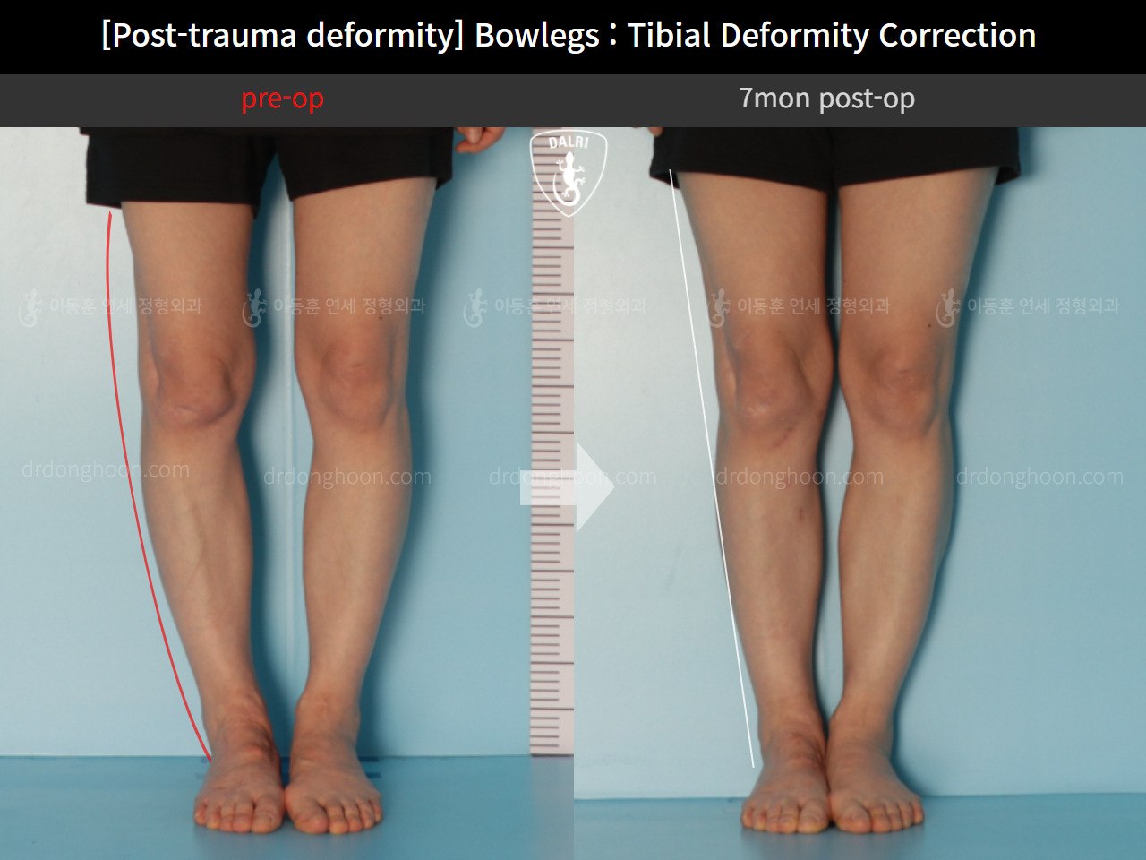 Before and after osteotomy for knee osteoarthritis, case 10389290, image 1, Dr. Donghoon institute (DALRI)
