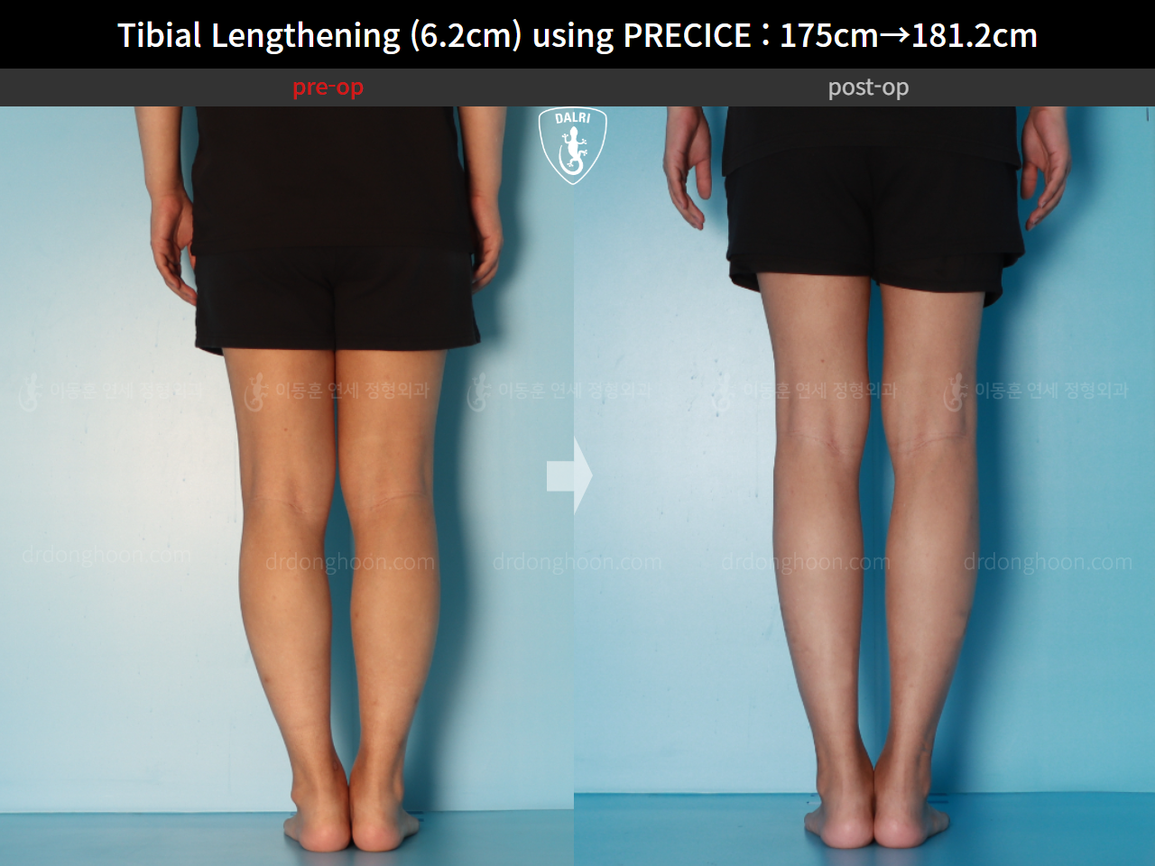 Before and after cll precice, case 16277428, image 10, Dr. Donghoon institute (DALRI)