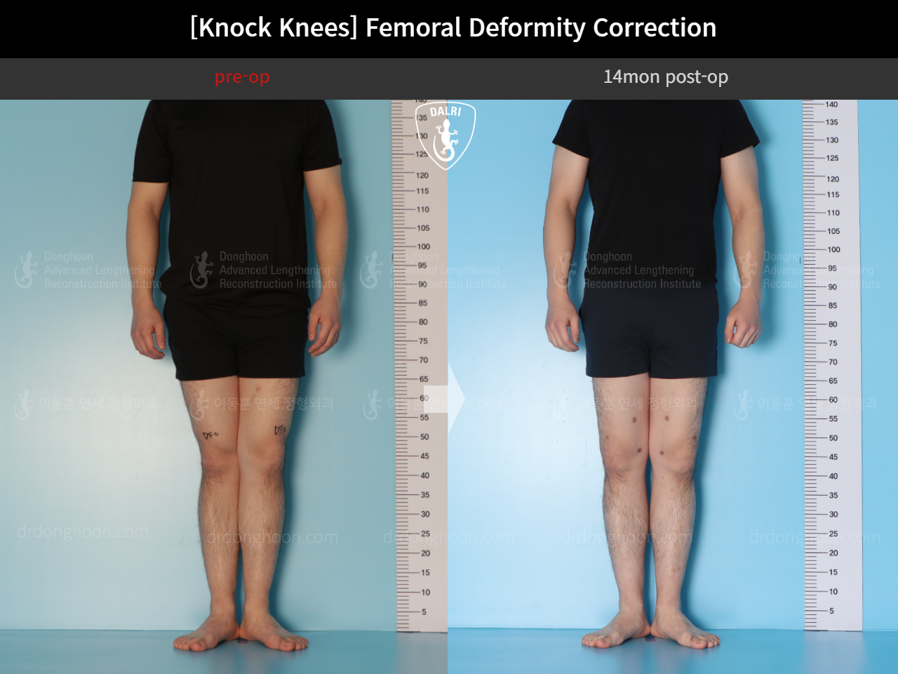 Before and after adult knock knees, case 15816319, image 4, Dr. Donghoon institute (DALRI)