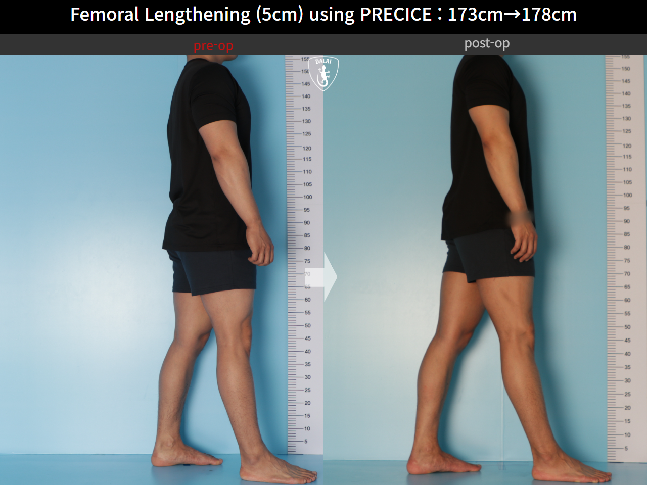 Before and after cll precice, case 21702609, image 5, Dr. Donghoon institute (DALRI)