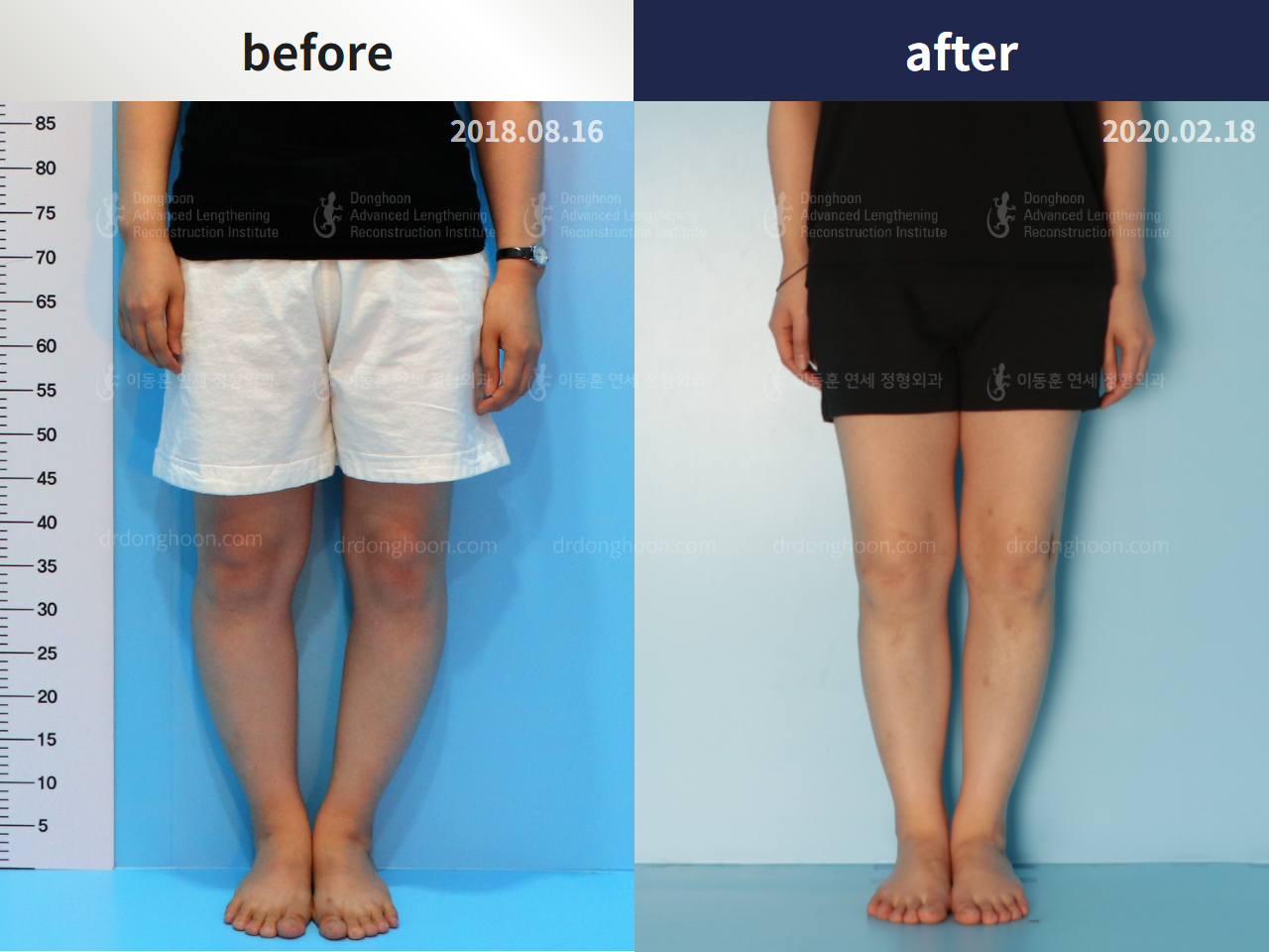 Before and after congenital condition, case 4304638, image 1, Dr. Donghoon institute (DALRI)