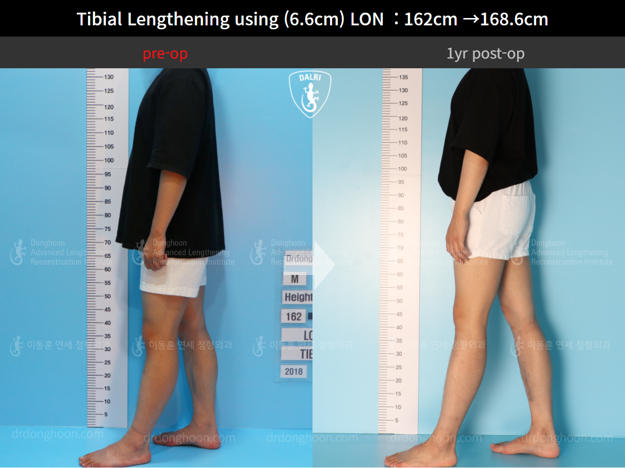 Before and after cll lon, case 4577769, image 3, Dr. Donghoon institute (DALRI)