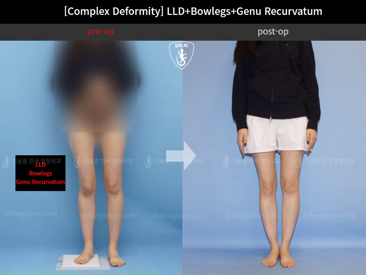 Before and after adult lld, case 11648318, image 1, Dr. Donghoon institute (DALRI)