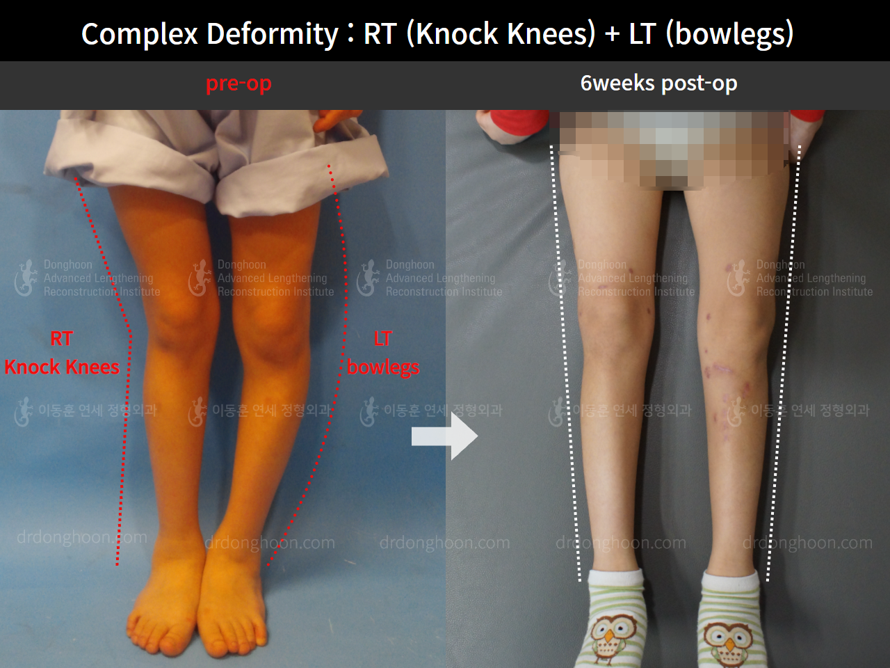 Before and after paediatric & adolescent knock knees, case 8618379, image 2, Dr. Donghoon institute (DALRI)