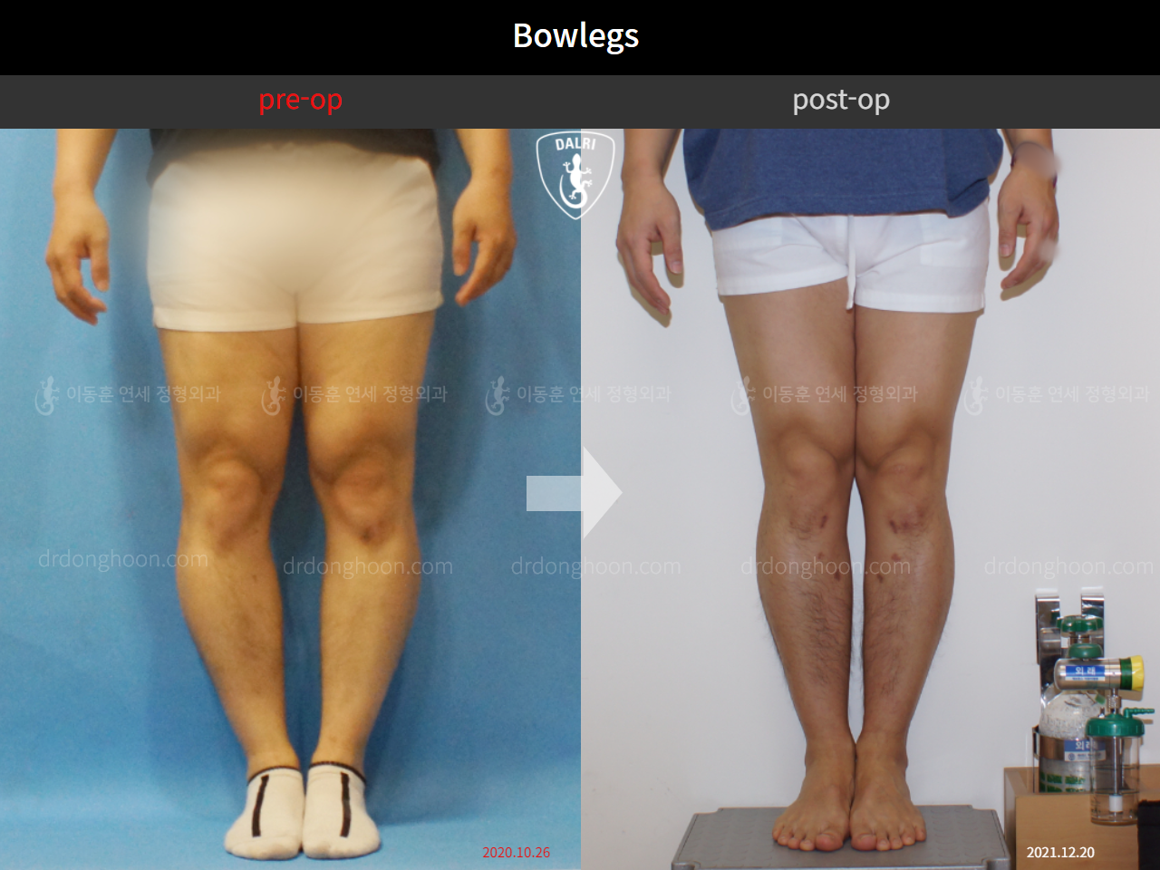 Before and after adult bowlegs, case 4311035, image 3, Dr. Donghoon institute (DALRI)