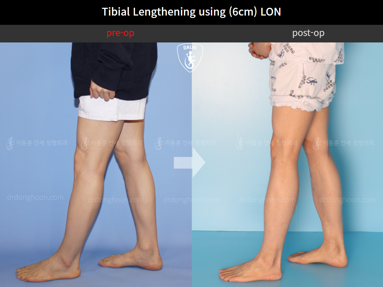 Before and after cll lon, case 4577694, image 8, Dr. Donghoon institute (DALRI)