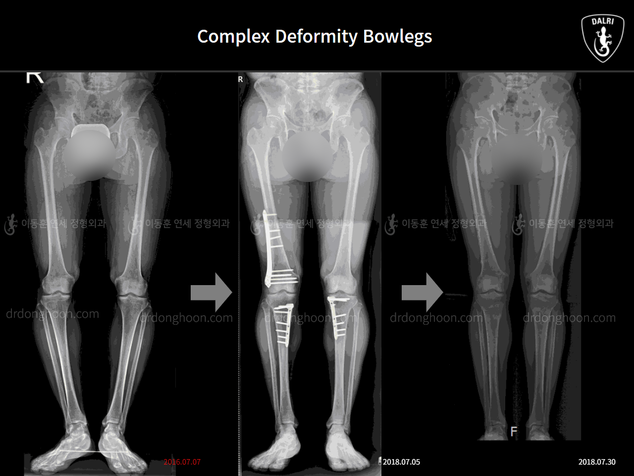 Before and after adult bowlegs, case 4311059, image 5, Dr. Donghoon institute (DALRI)