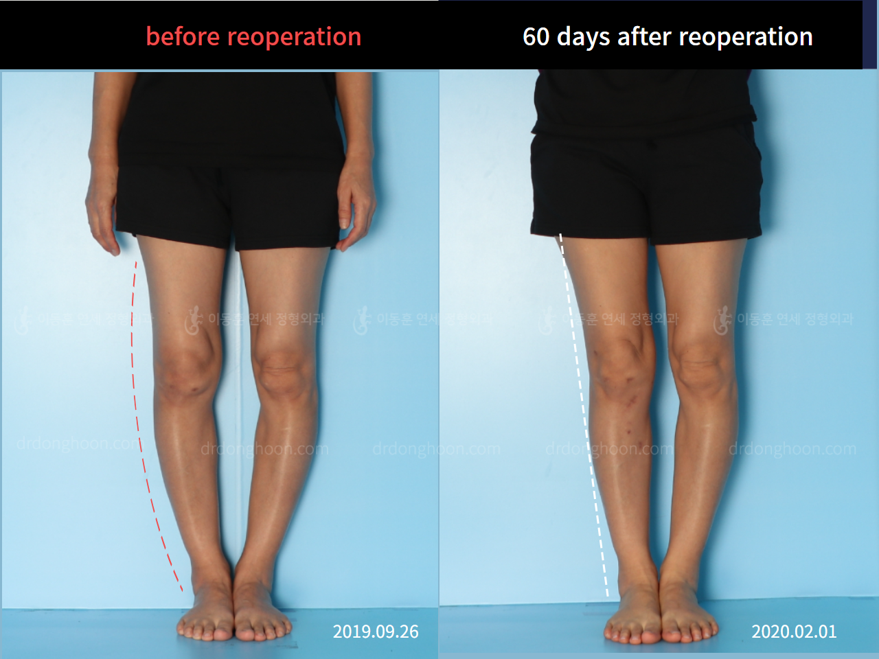 Before and after reoperation after deformity correction, case 4579277, image 2, Dr. Donghoon institute (DALRI)