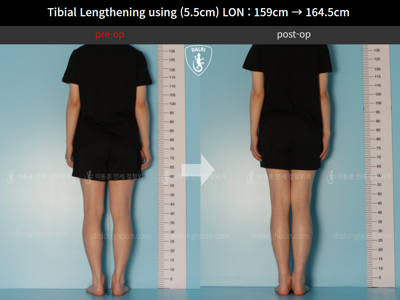 Before and after cll lon, case 11747999, image 2, Dr. Donghoon institute (DALRI)