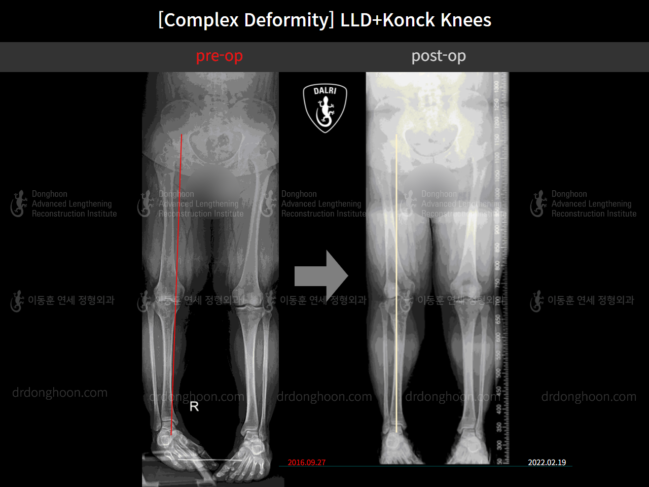 Before and after adult lld, case 10564254, image 8, Dr. Donghoon institute (DALRI)