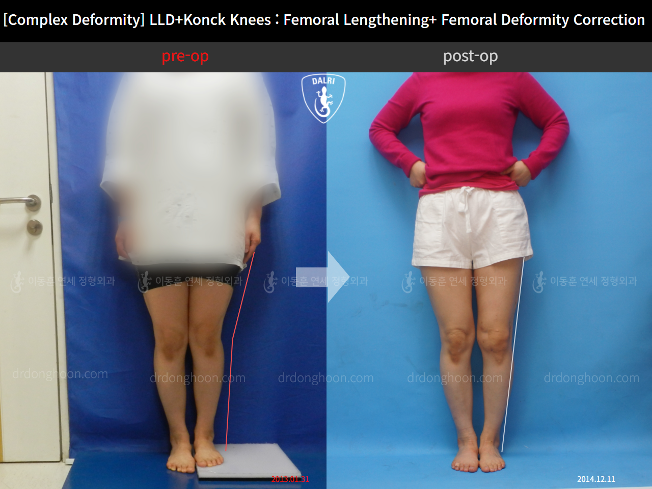 Before and after adult lld, case 11107365, image 1, Dr. Donghoon institute (DALRI)