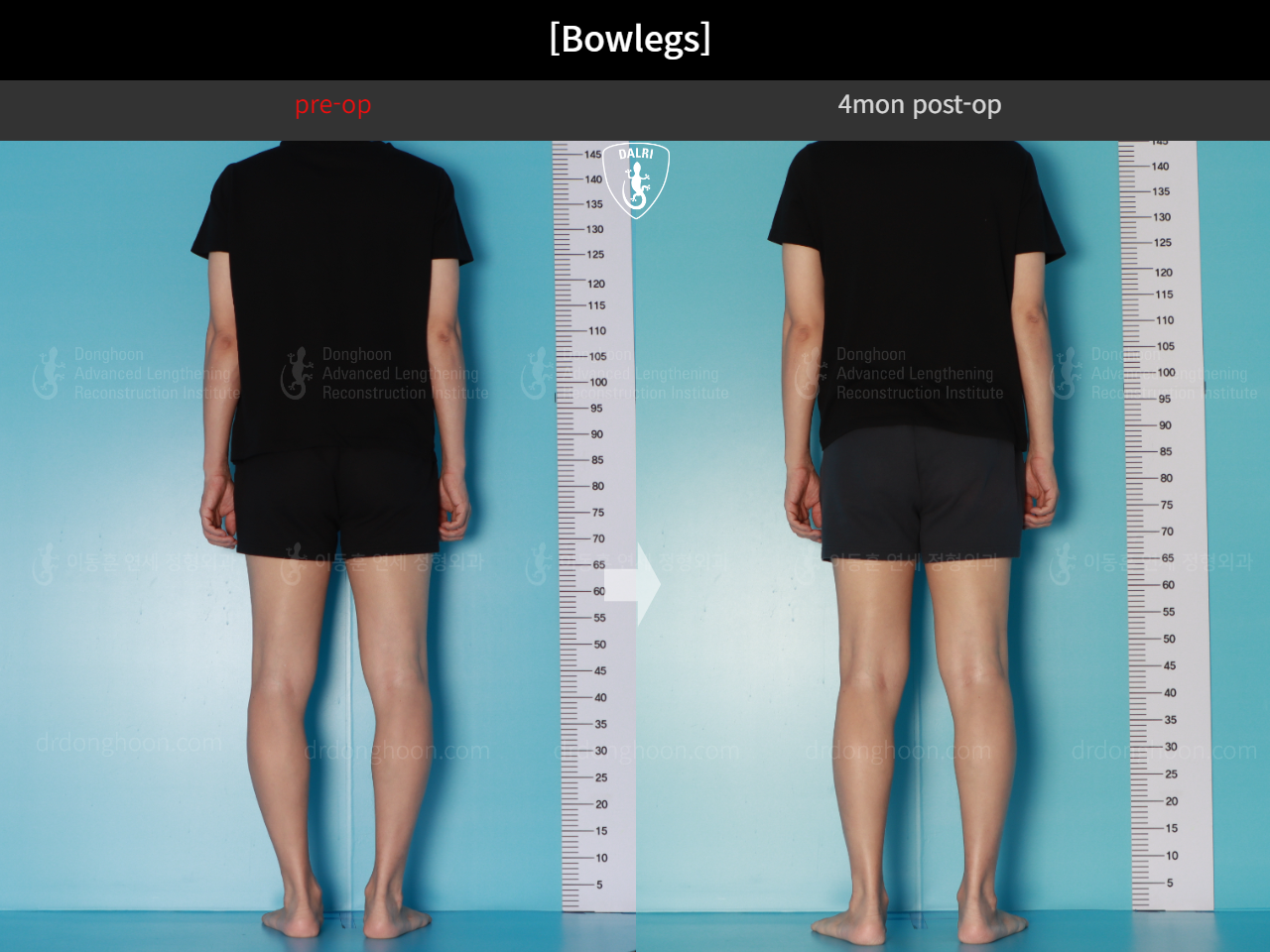 Before and after adult bowlegs, case 17962599, image 5, Dr. Donghoon institute (DALRI)