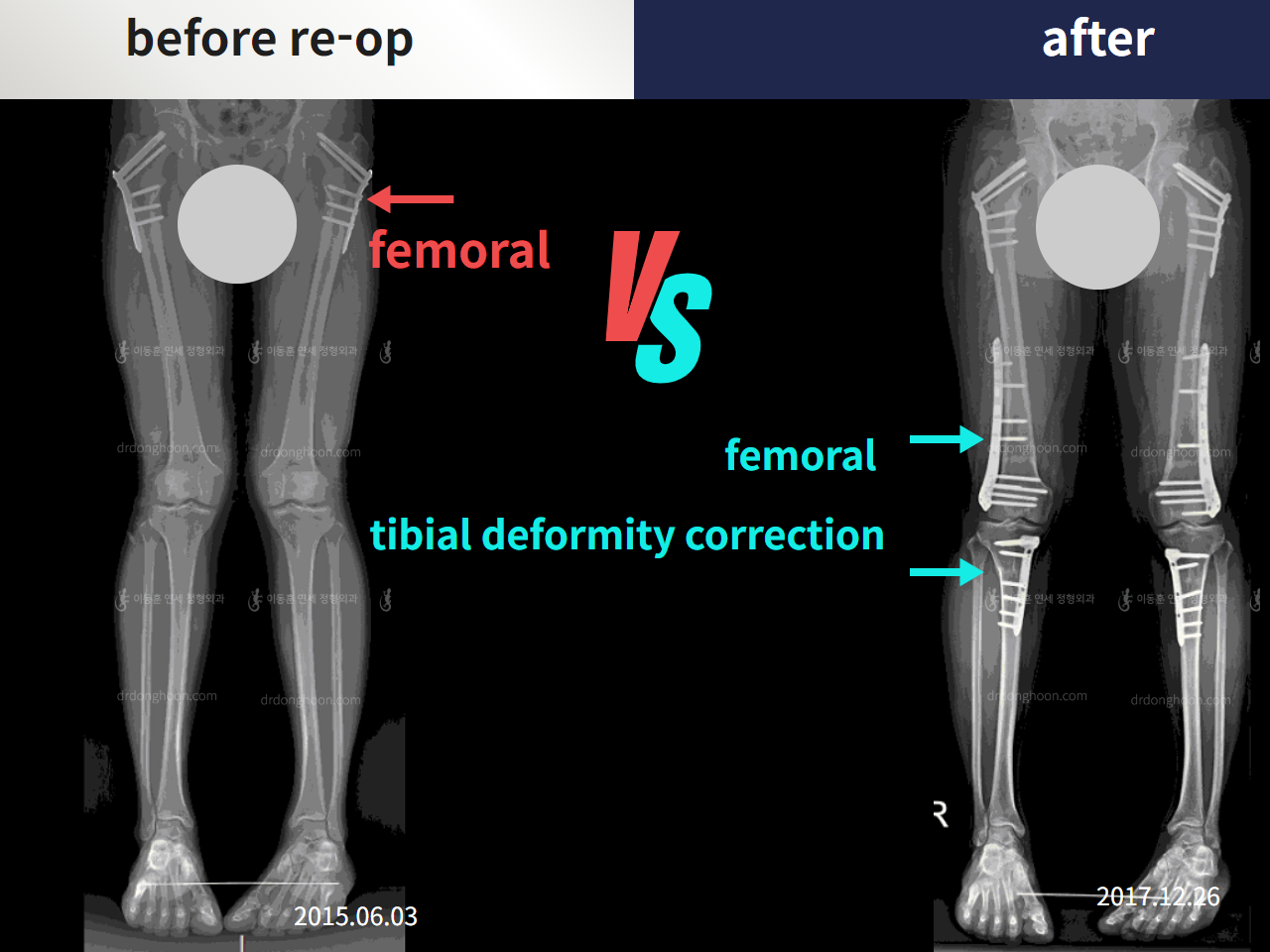 Before and after reoperation after deformity correction, case 4306345, image 3, Dr. Donghoon institute (DALRI)