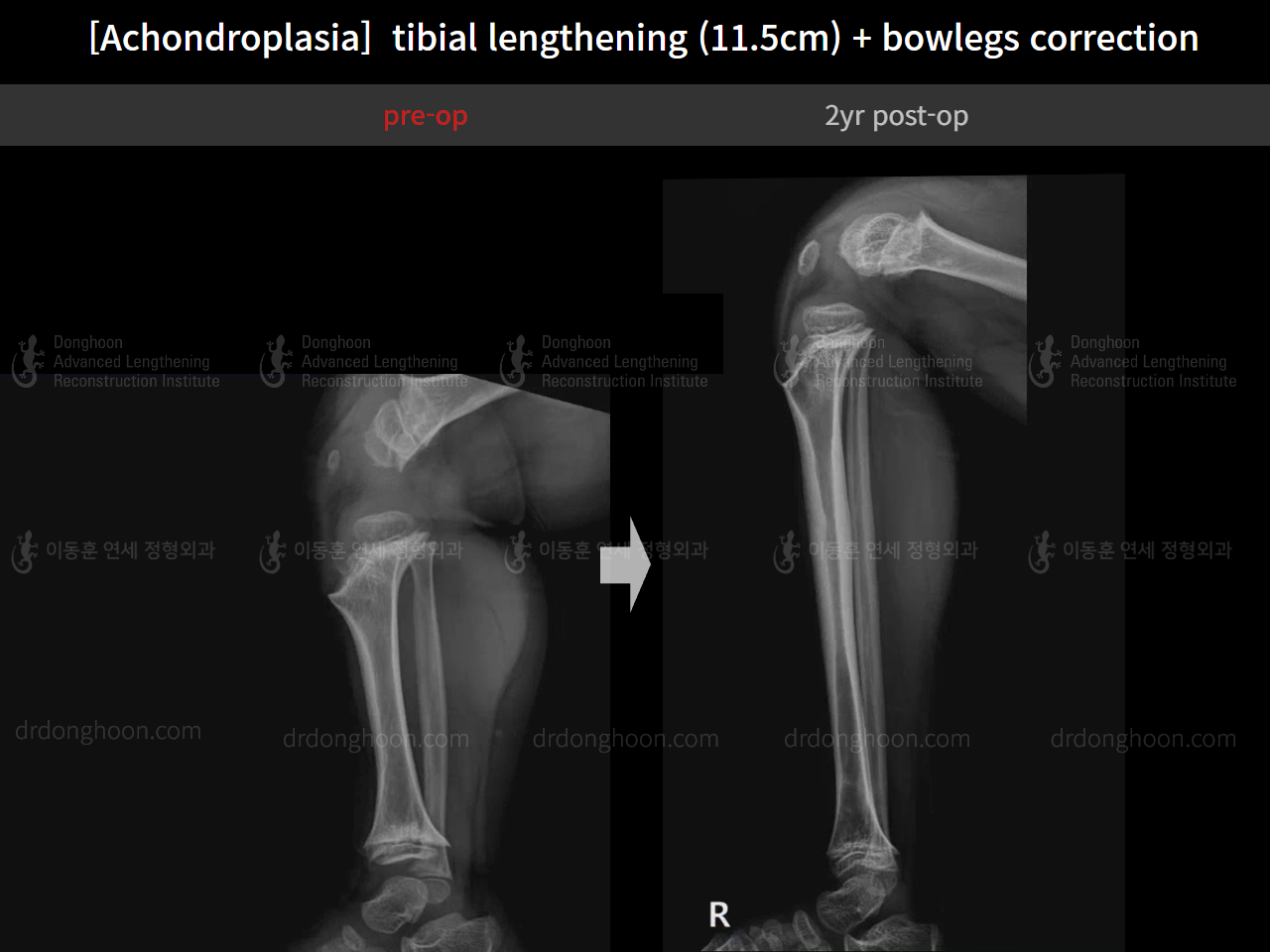 Before and after paediatric congenital condition, case 14957539, image 8, Dr. Donghoon institute (DALRI)