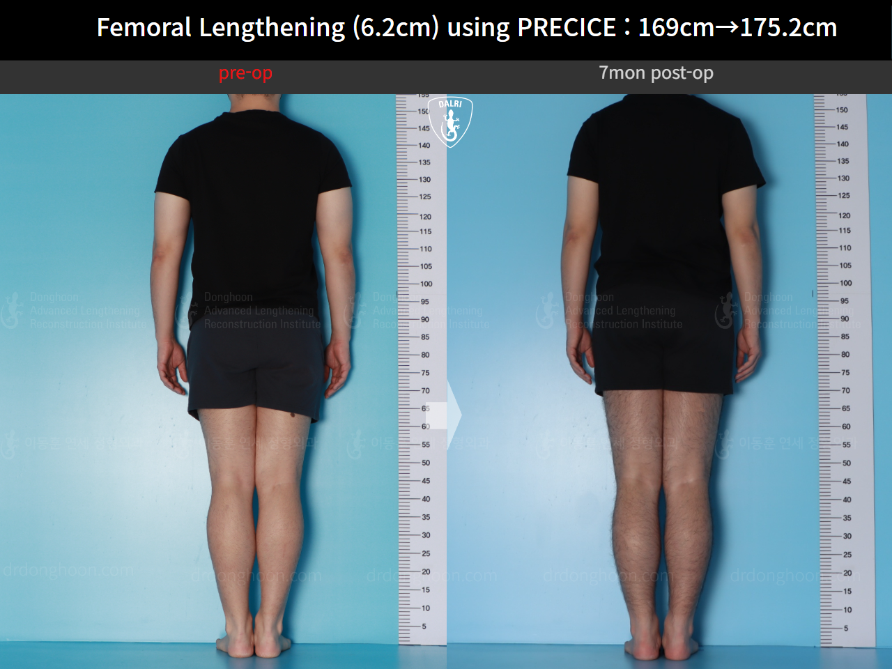 Before and after cll precice, case 20671201, image 2, Dr. Donghoon institute (DALRI)