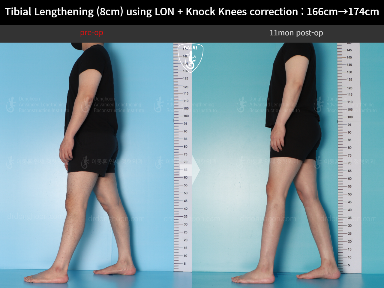 Before and after cll + deformity correction, case 20789954, image 5, Dr. Donghoon institute (DALRI)