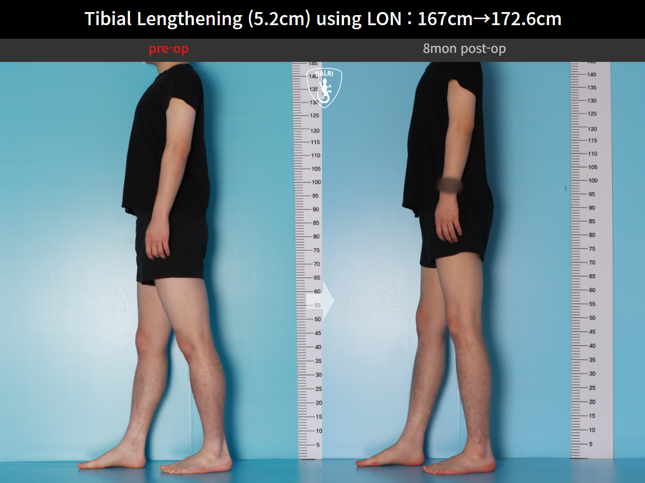 Before and after cll lon, case 29672720, image 4, Dr. Donghoon institute (DALRI)