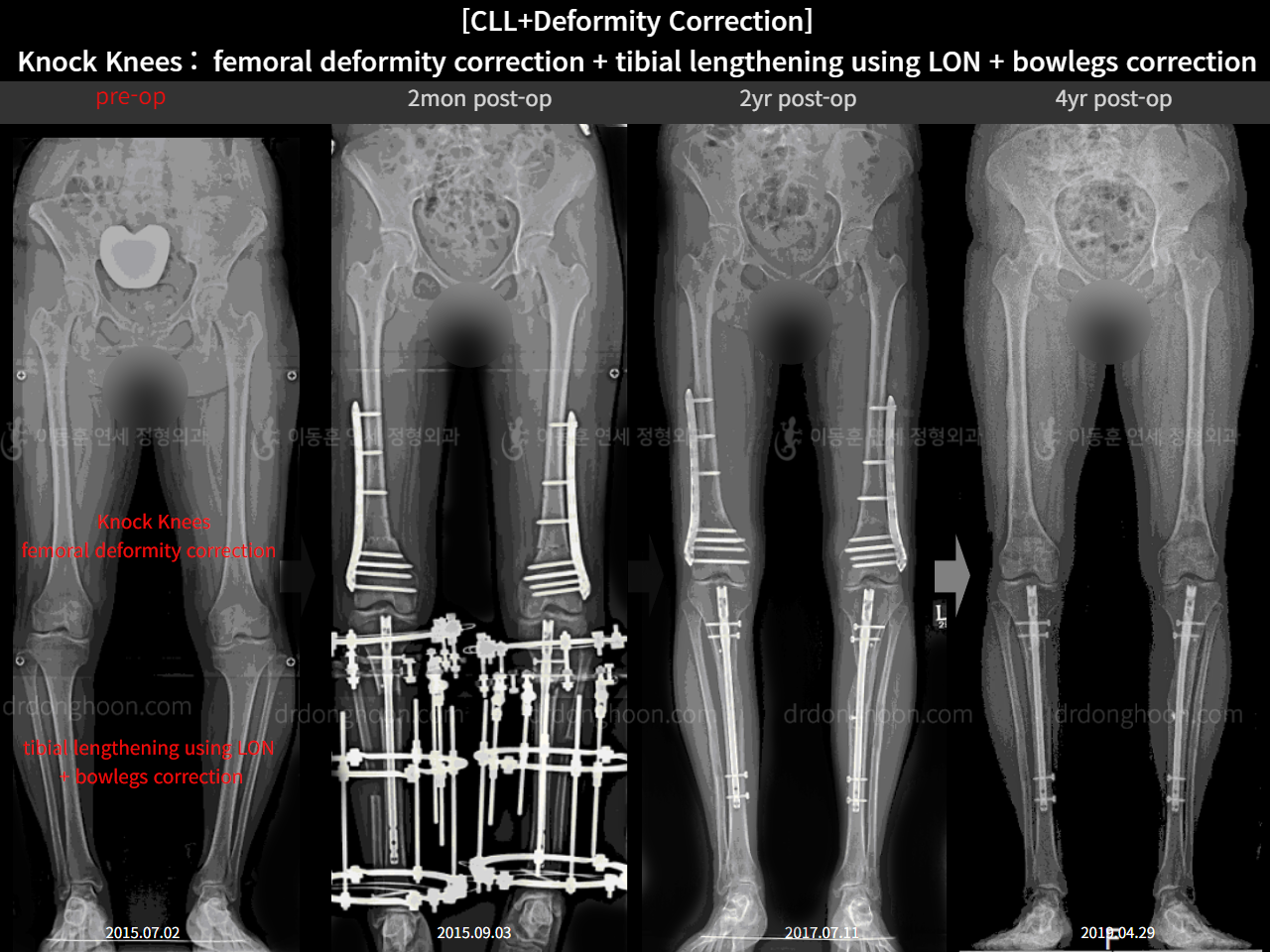 Before and after complex deformity, case 16102792, image 1, Dr. Donghoon institute (DALRI)