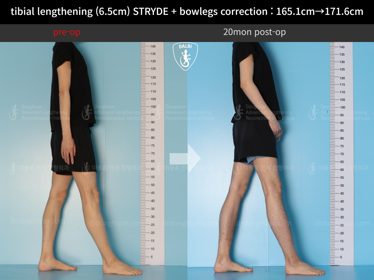 Before and after cll + deformity correction, case 13168253, image 5, Dr. Donghoon institute (DALRI)
