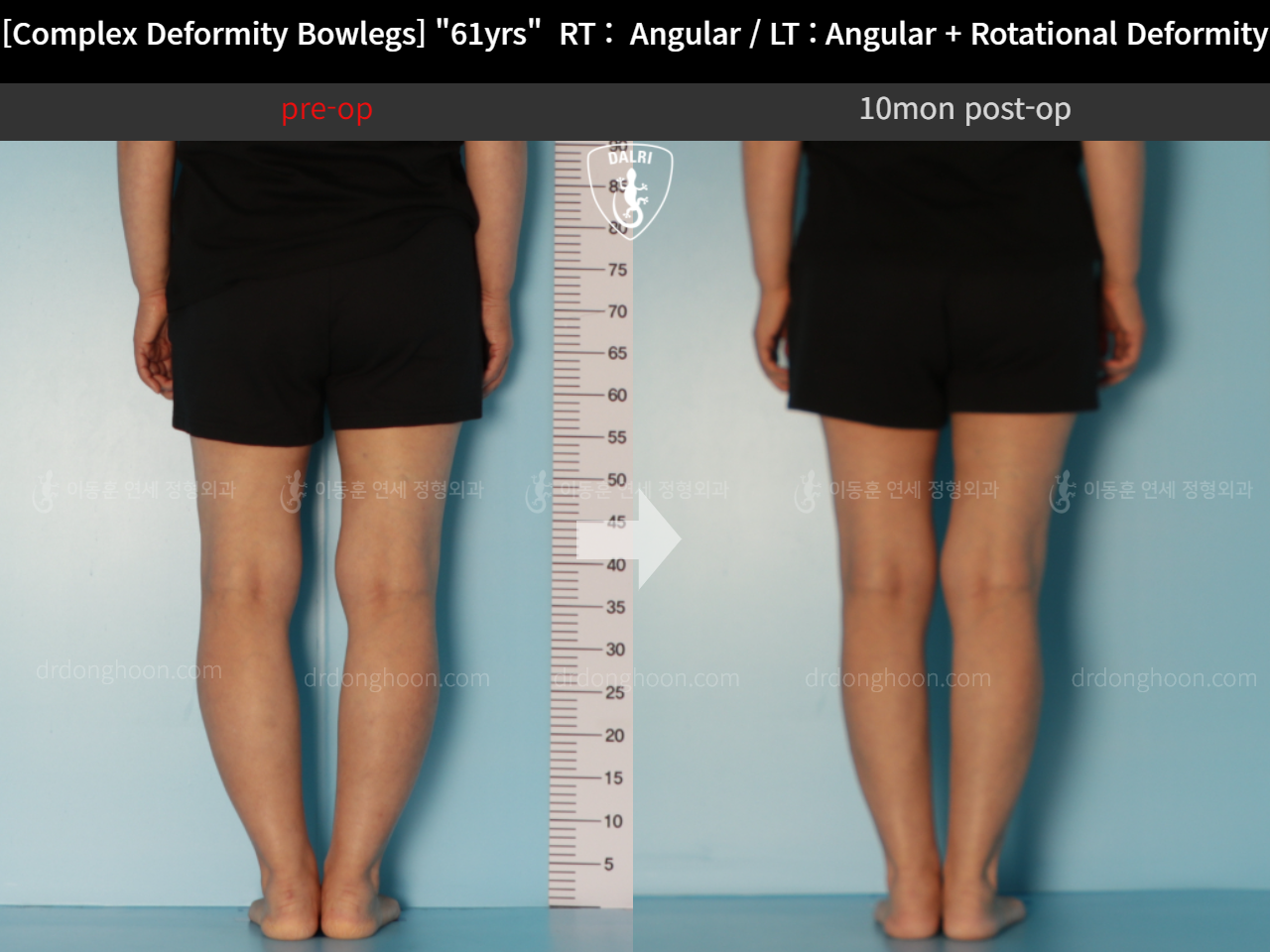 Before and after osteotomy for knee osteoarthritis, case 11576611, image 6, Dr. Donghoon institute (DALRI)