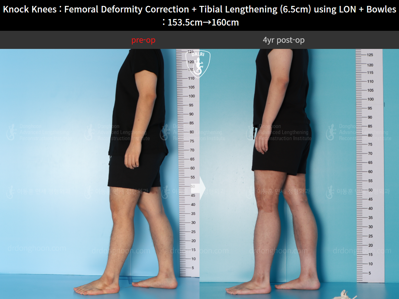 Before and after cll lon, case 16723818, image 4, Dr. Donghoon institute (DALRI)