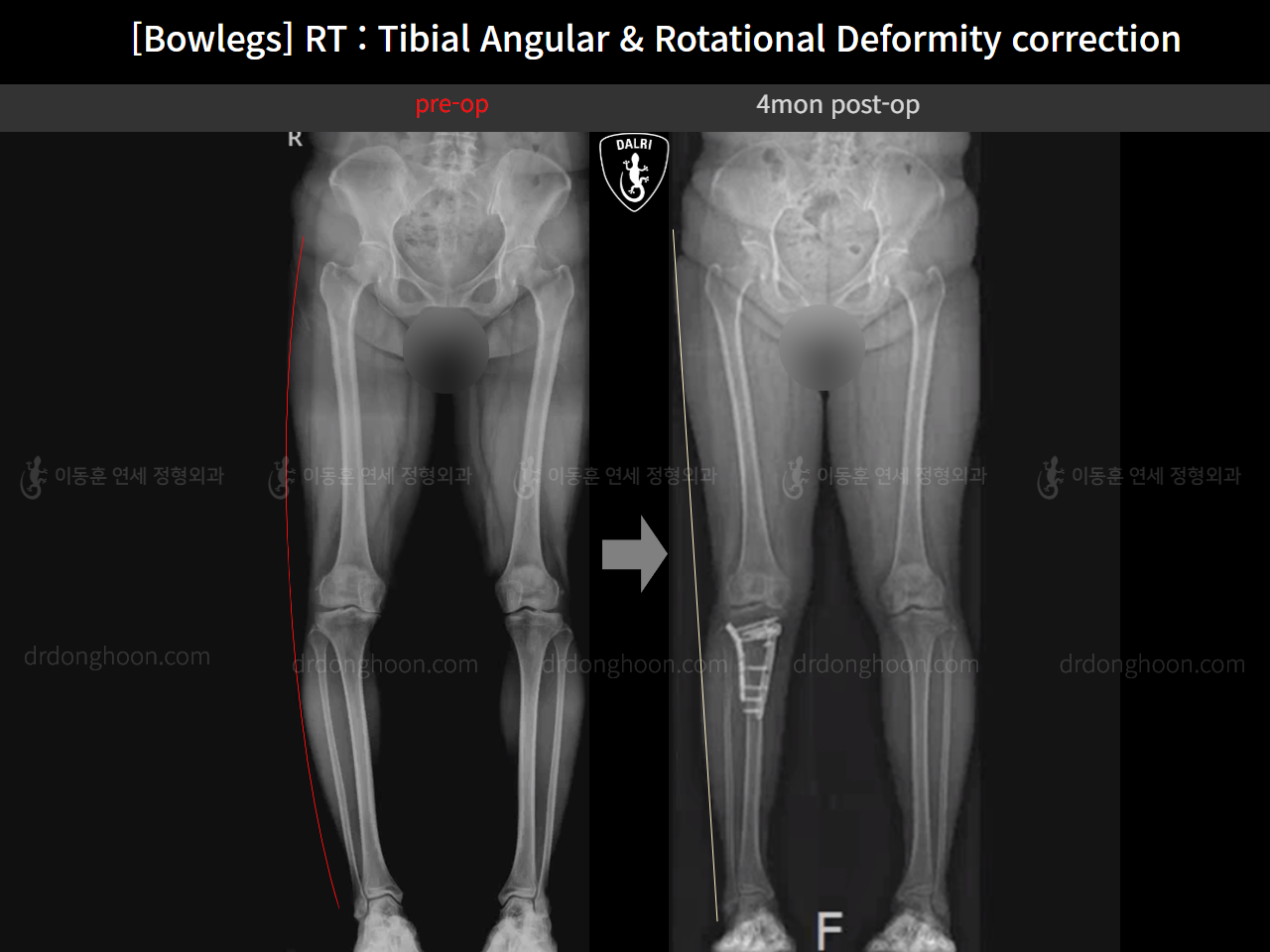 Before and after adult bowlegs, case 15741874, image 12, Dr. Donghoon institute (DALRI)