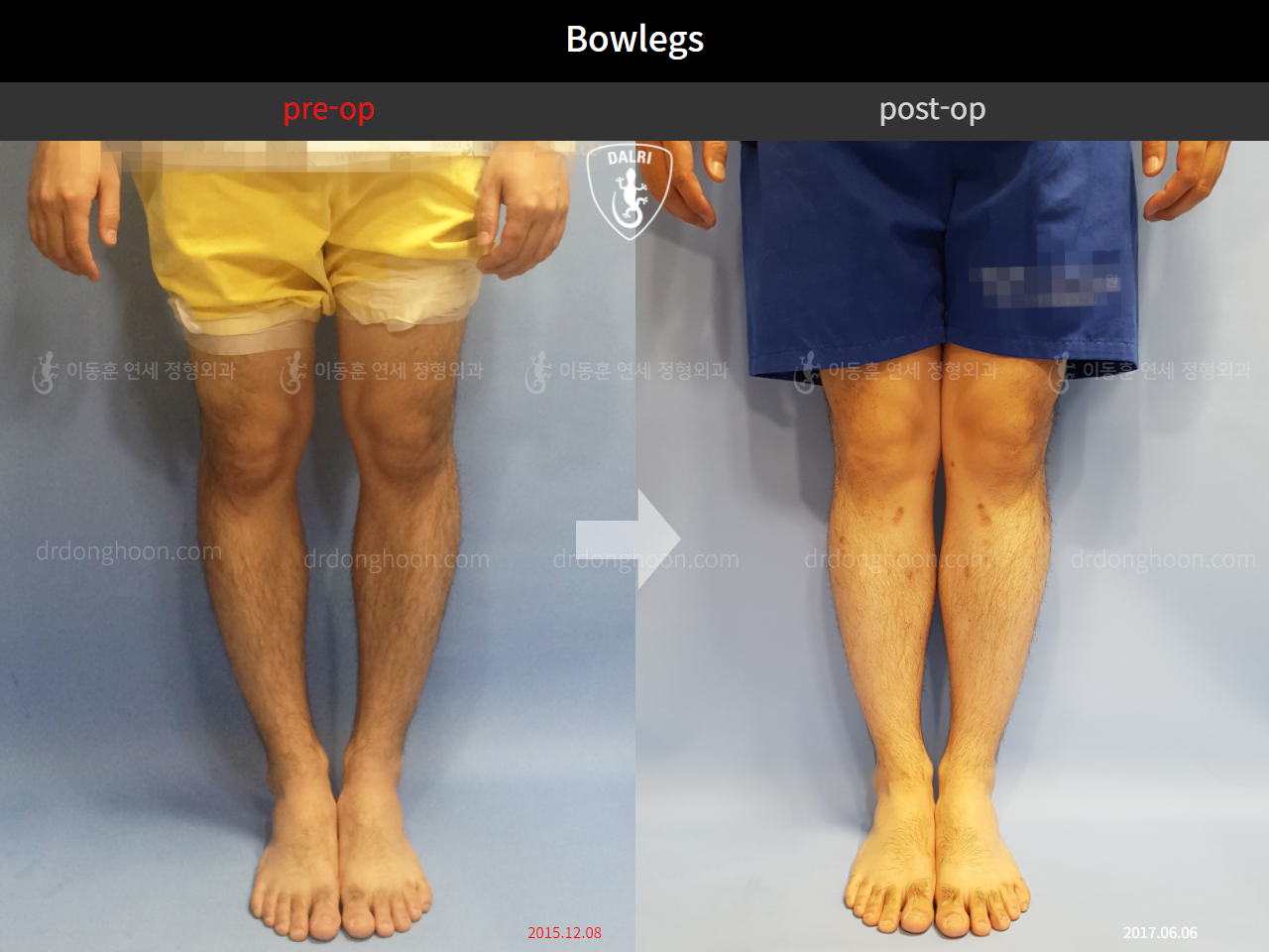 Before and after adult bowlegs, case 10629004, image 1, Dr. Donghoon institute (DALRI)