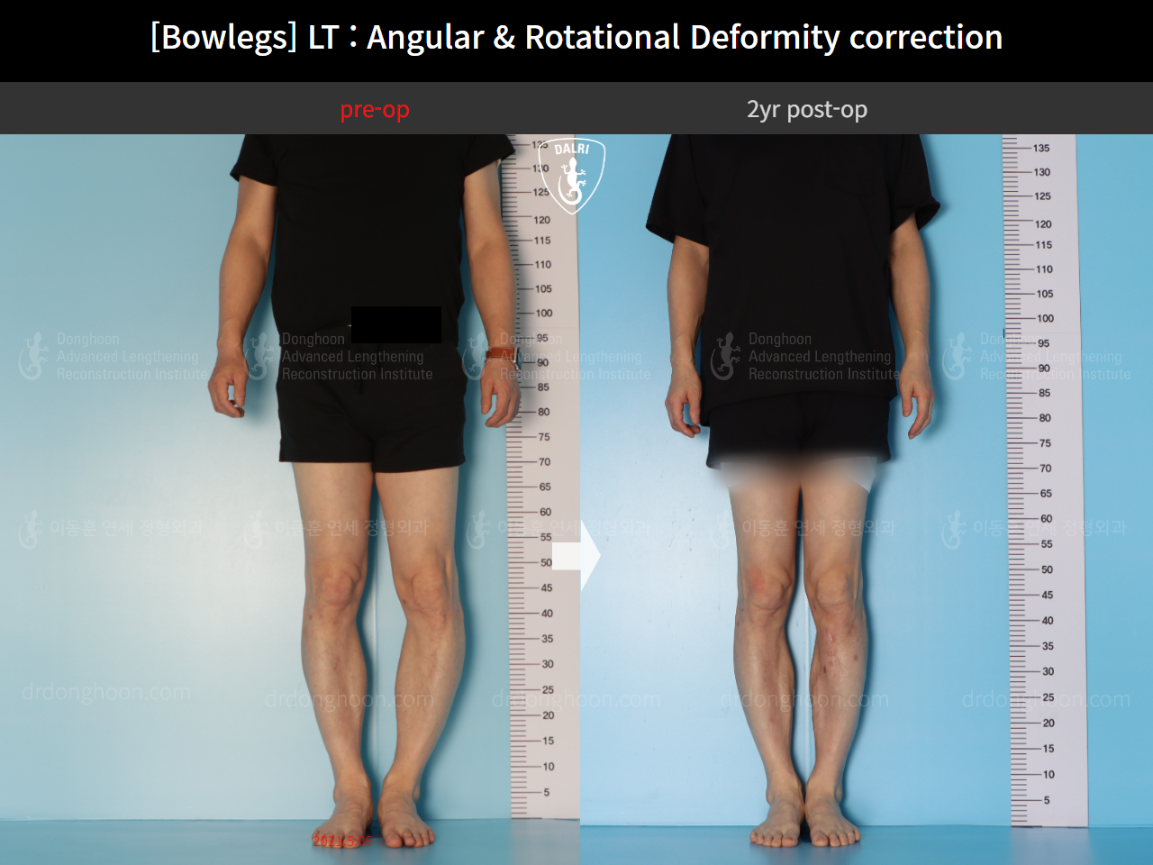Before and after adult bowlegs, case 15111863, image 3, Dr. Donghoon institute (DALRI)