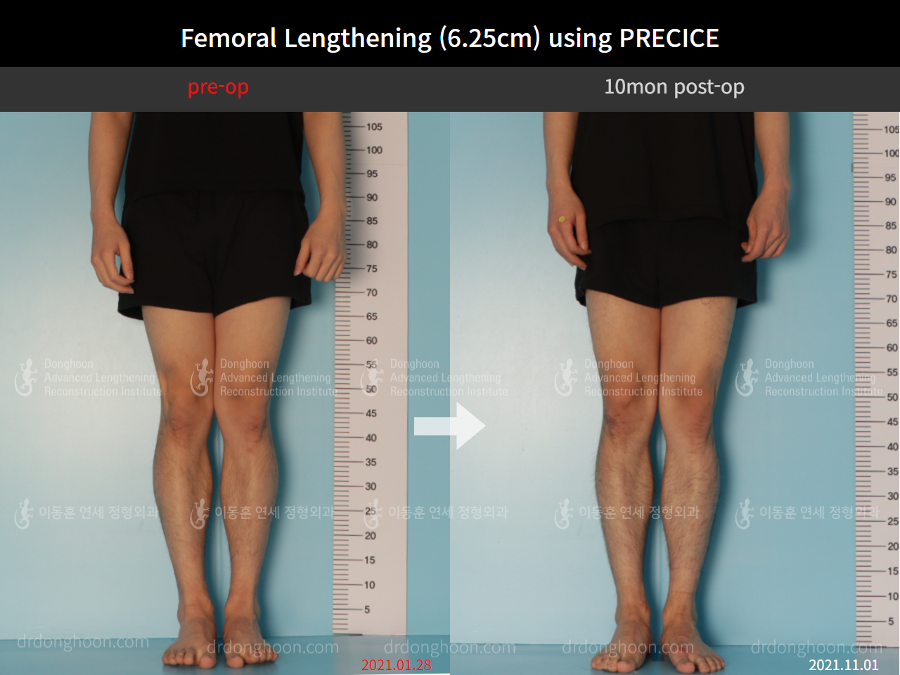 Before and after cll precice, case 8759307, image 5, Dr. Donghoon institute (DALRI)