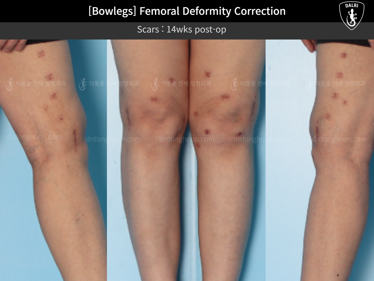 Before and after adult bowlegs, case 12791222, image 6, Dr. Donghoon institute (DALRI)