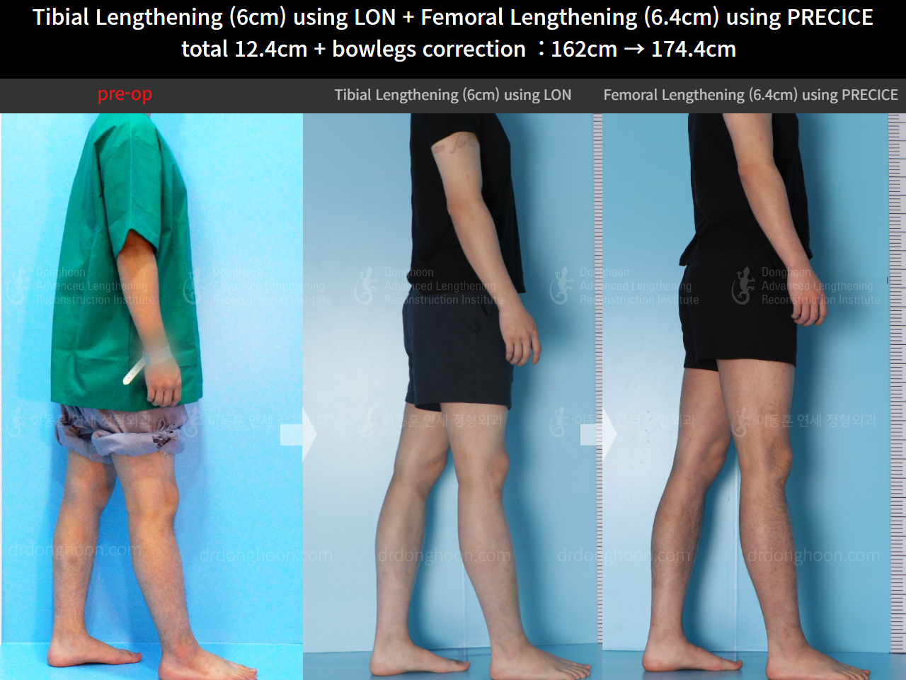 Before and after cll precice, case 14631295, image 3, Dr. Donghoon institute (DALRI)
