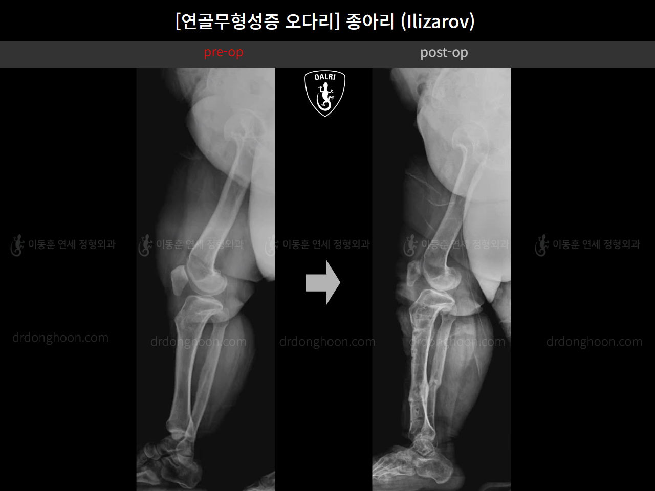 Before and after congenital condition, case 18077774, image 8, Dr. Donghoon institute (DALRI)