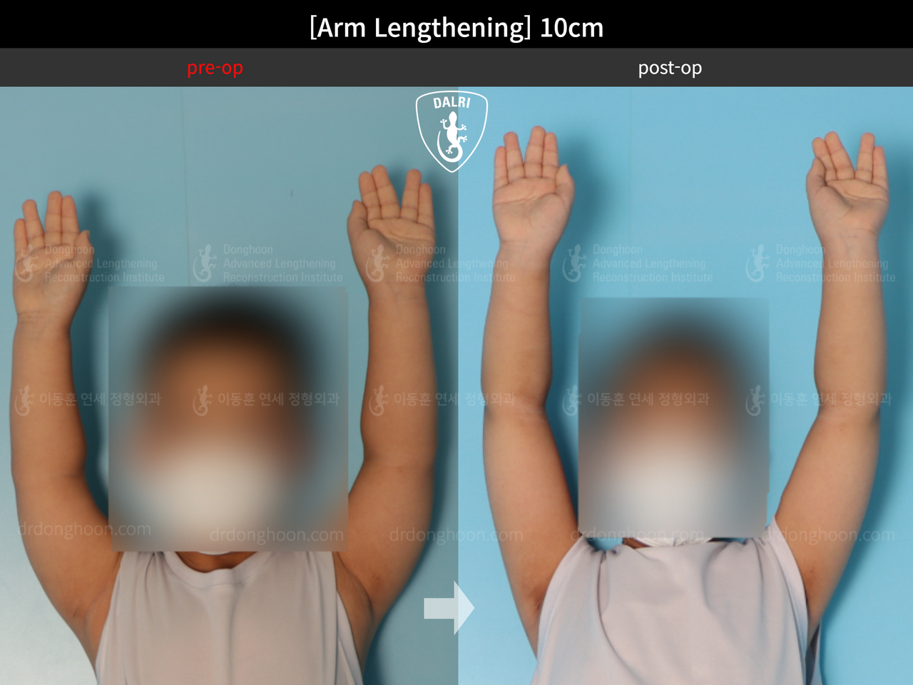 Before and after arm lengthening, case 13536914, image 3, Dr. Donghoon institute (DALRI)