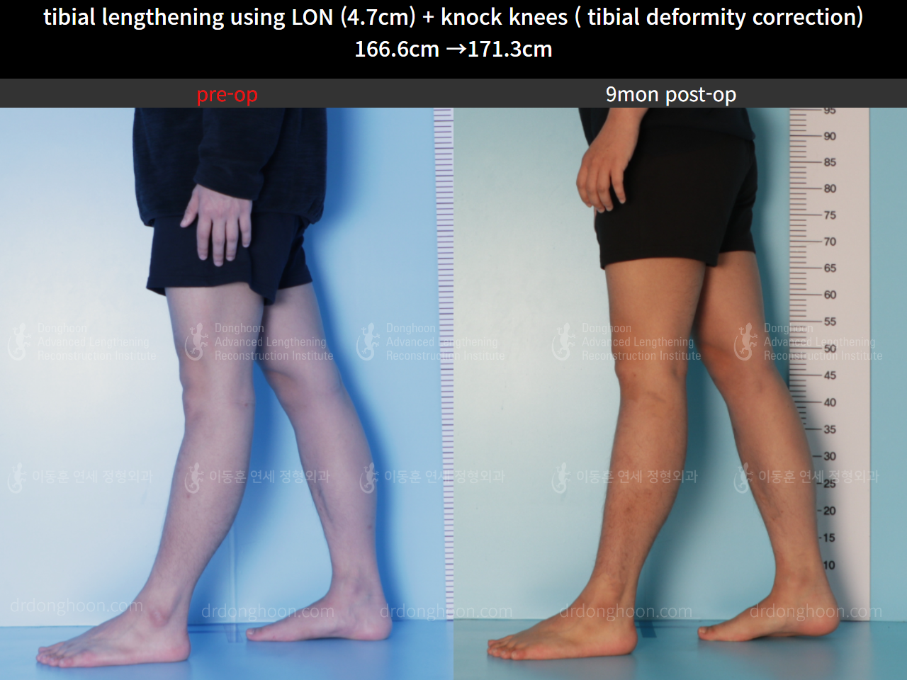 Before and after cll + deformity correction, case 8583829, image 7, Dr. Donghoon institute (DALRI)