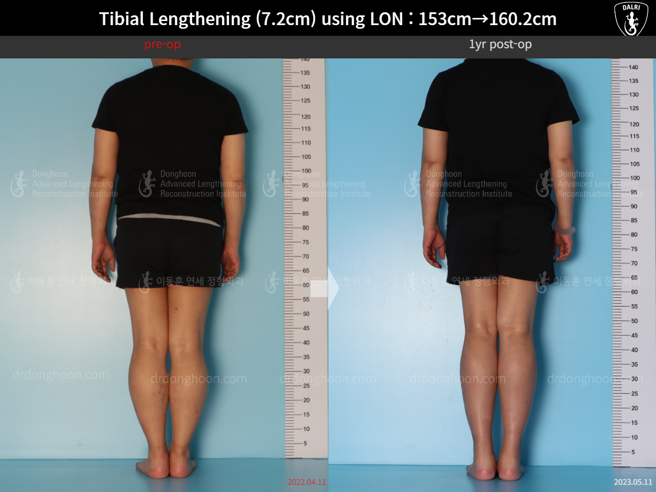 Before and after cll lon, case 15150707, image 2, Dr. Donghoon institute (DALRI)