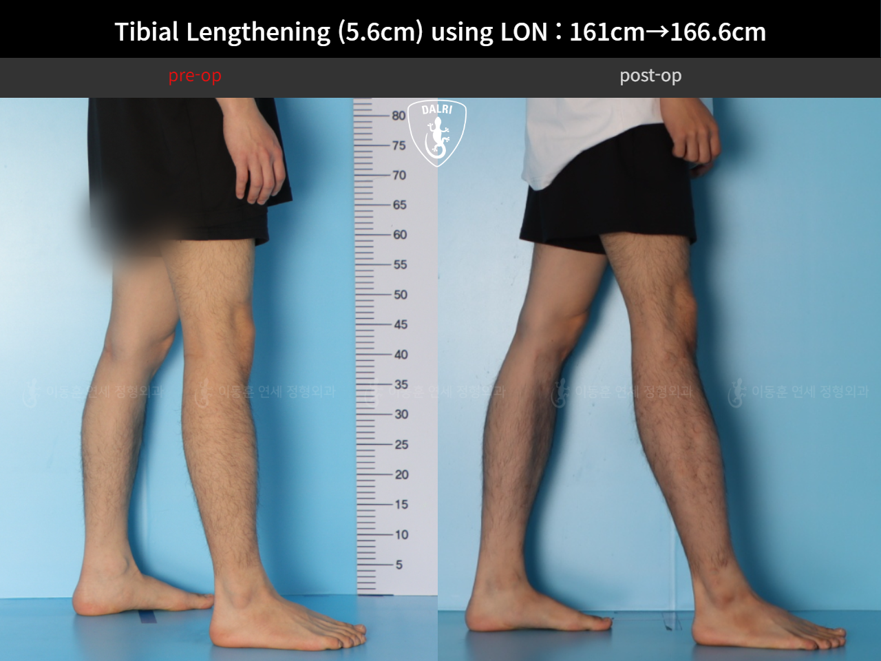 Before and after cll lon, case 126542150, image 8, Dr. Donghoon institute (DALRI)