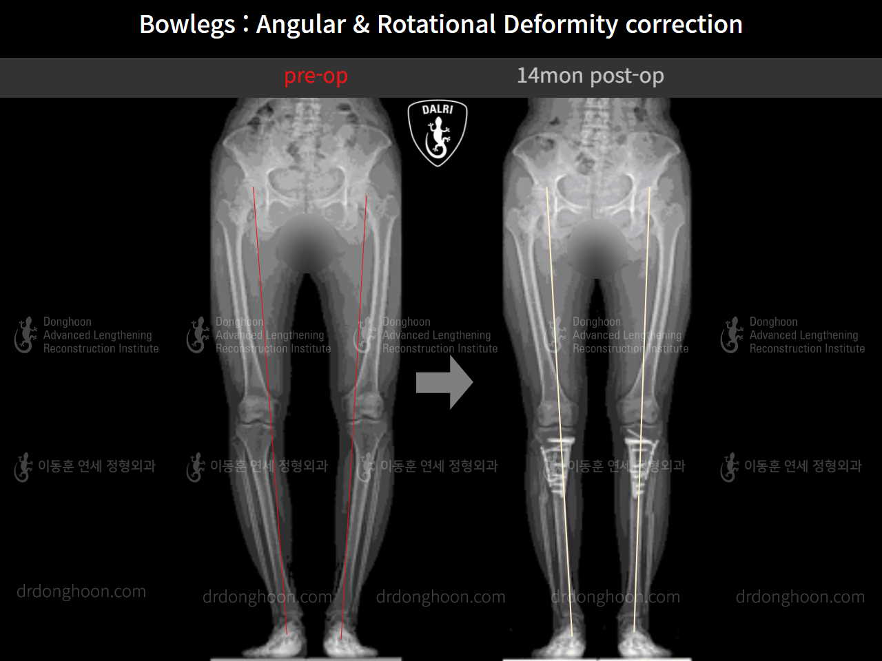 Before and after adult bowlegs, case 9557826, image 8, Dr. Donghoon institute (DALRI)