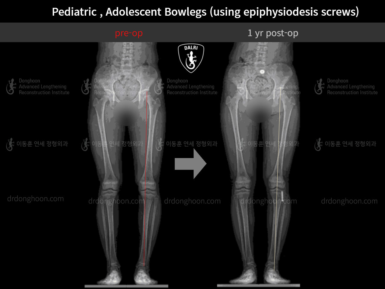 Before and after paediatric & adolescent bowlegs, case 9259159, image 5, Dr. Donghoon institute (DALRI)